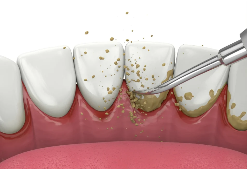 Teeth Cleaning (Scaling & Polishing)